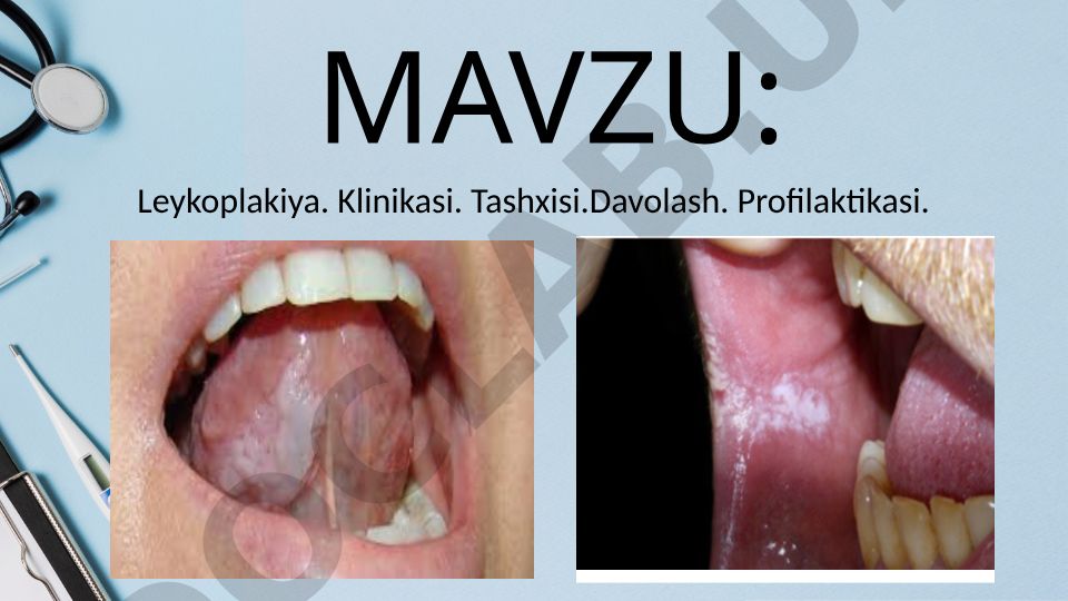 Leykoplakiya. Klinikasi. Tashxisi. Davolash. Profilaktikasi