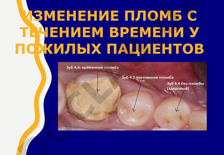 Изменение цвета зубных пломб у пожилых пациентов