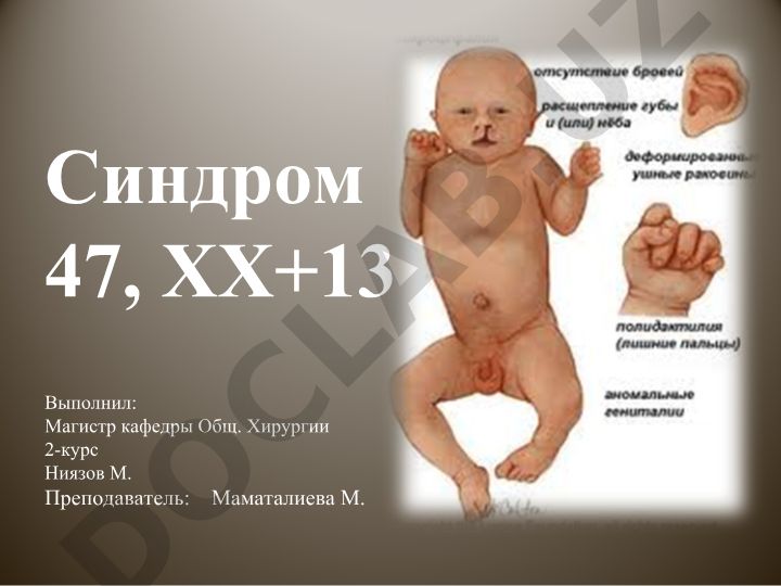 Синдром Патау (трисомия 13) - хромосомная аномалия