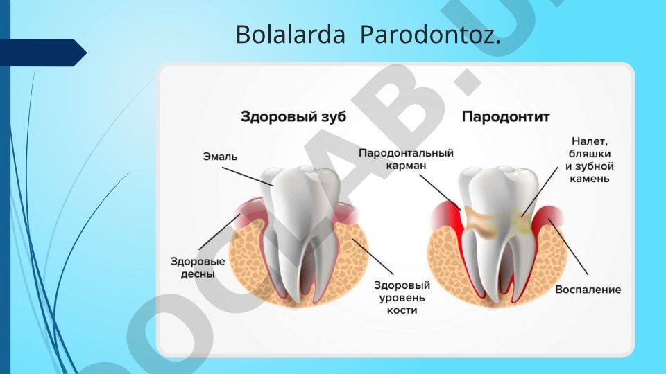 Bolalarda parodontoz kasalligi: sabablari va alomatlari