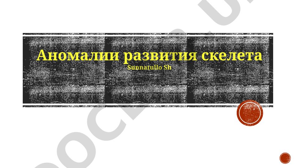 Аномалии развития скелета у плода и новорожденных
