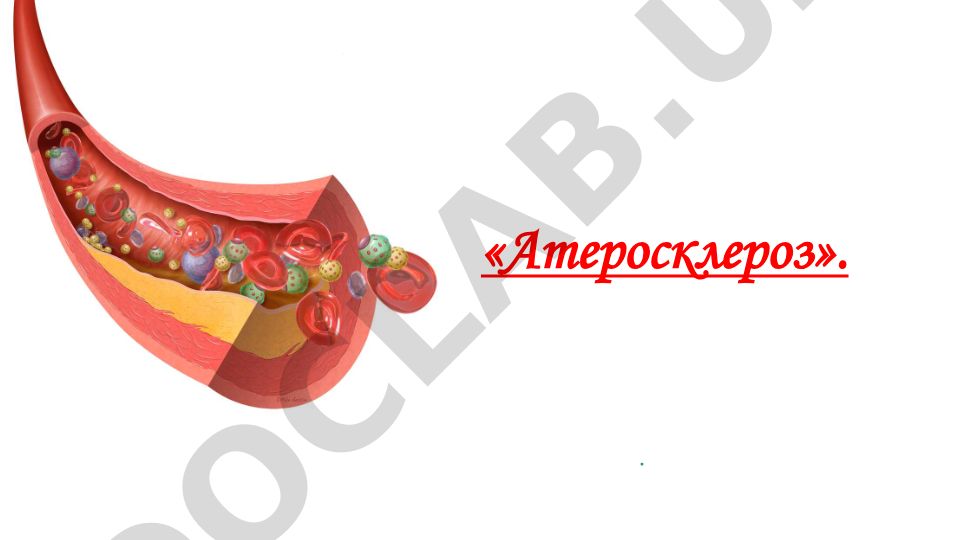 Атеросклероз