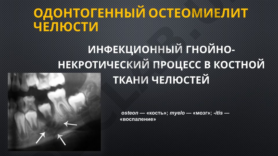 Одонтогенный остеомиелит челюсти: этиология, патогенез и теории развития