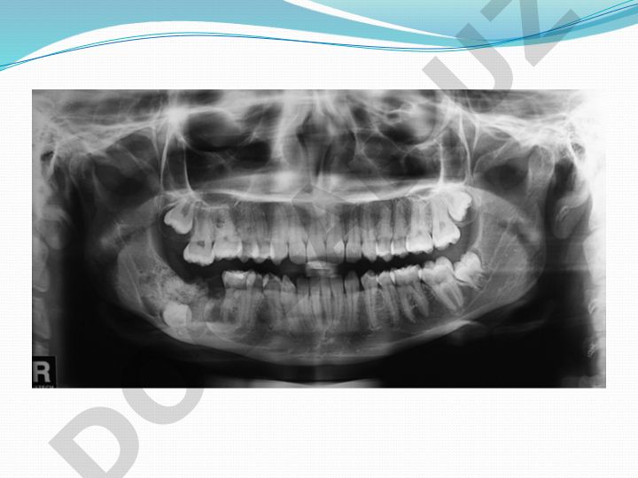 Included Tooth Extraction and Mandibular Lesion Surgery Case