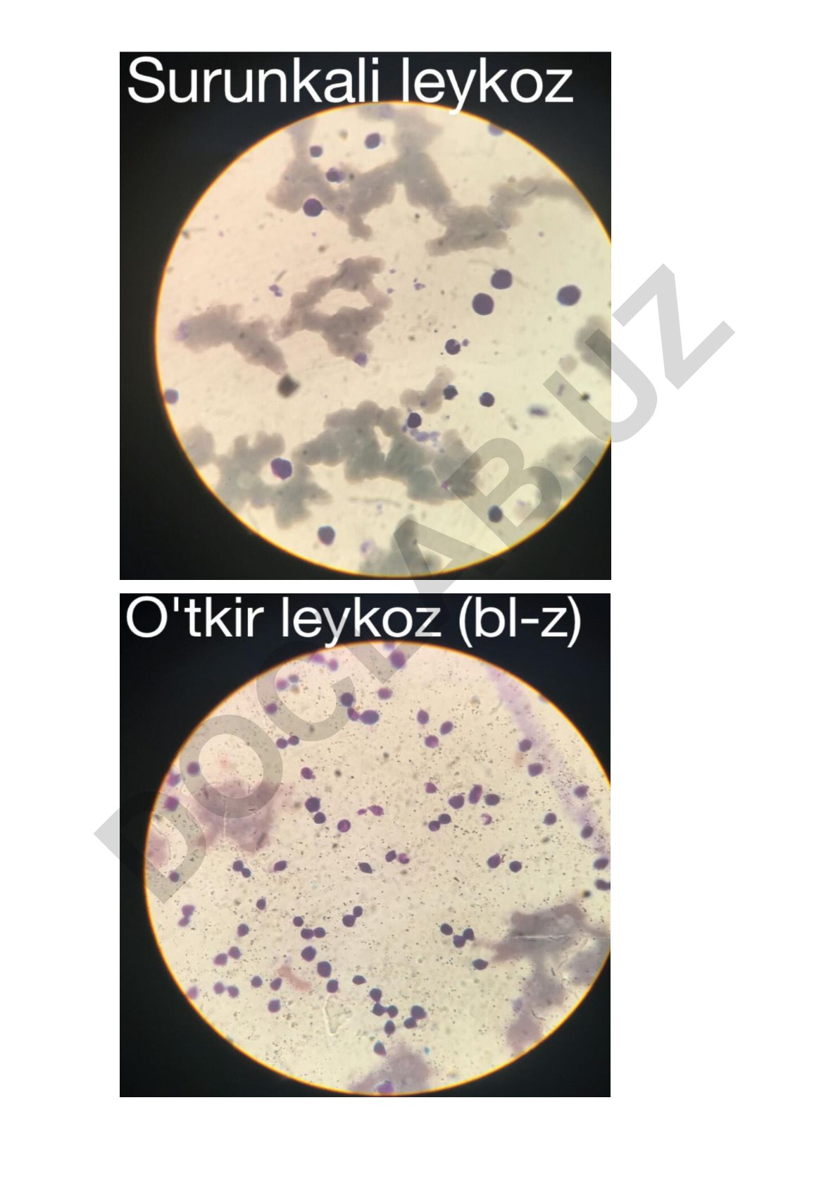Vitamin B12 yetishmovchiligi va gemotoksik anemiya