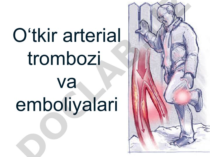 O‘tkir arterial trombozi va emboliyalari