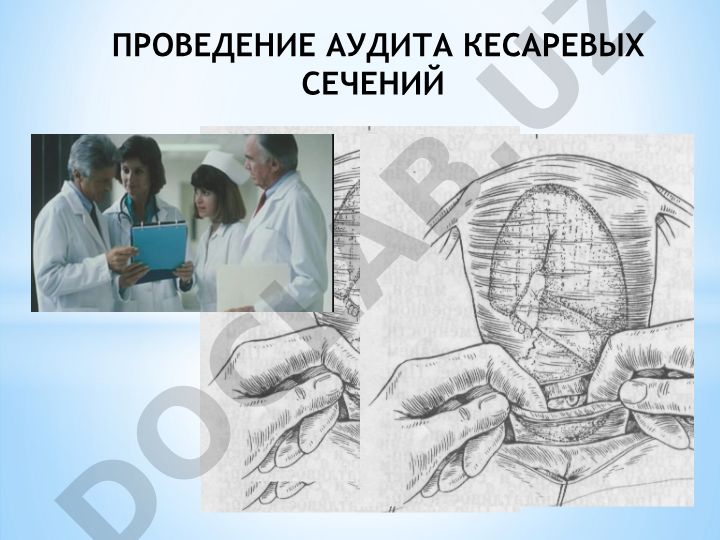 Проведение аудита кесаревых сечений с использованием классификации ROBSON