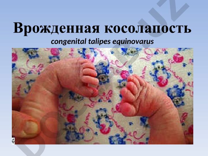 Врожденная косолапость (congenital talipes equinovarus)