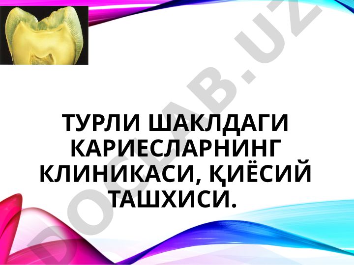 Тиш кариесининг клиникаси, қиёсий ташхиси ва тарқалиши