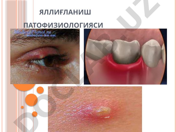 Яллиғланиш патологияси ва этиологияси