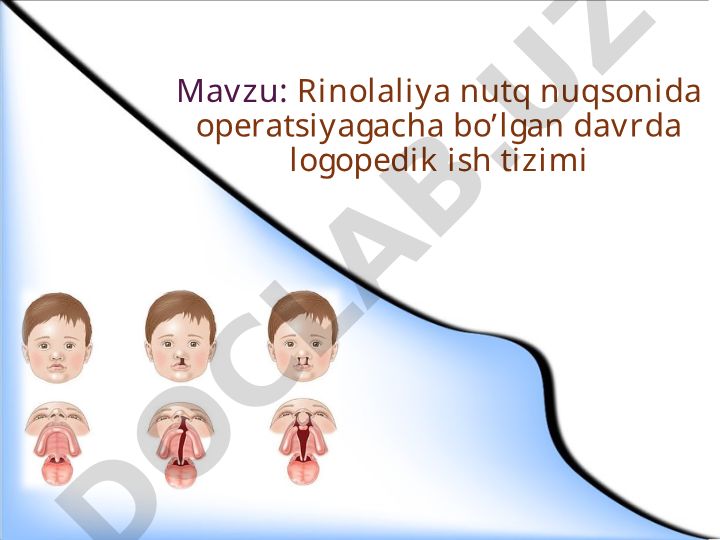 Rinolaliya nutq nuqsonida operatsiyagacha bo'lgan davrda logopedik ish tizimi