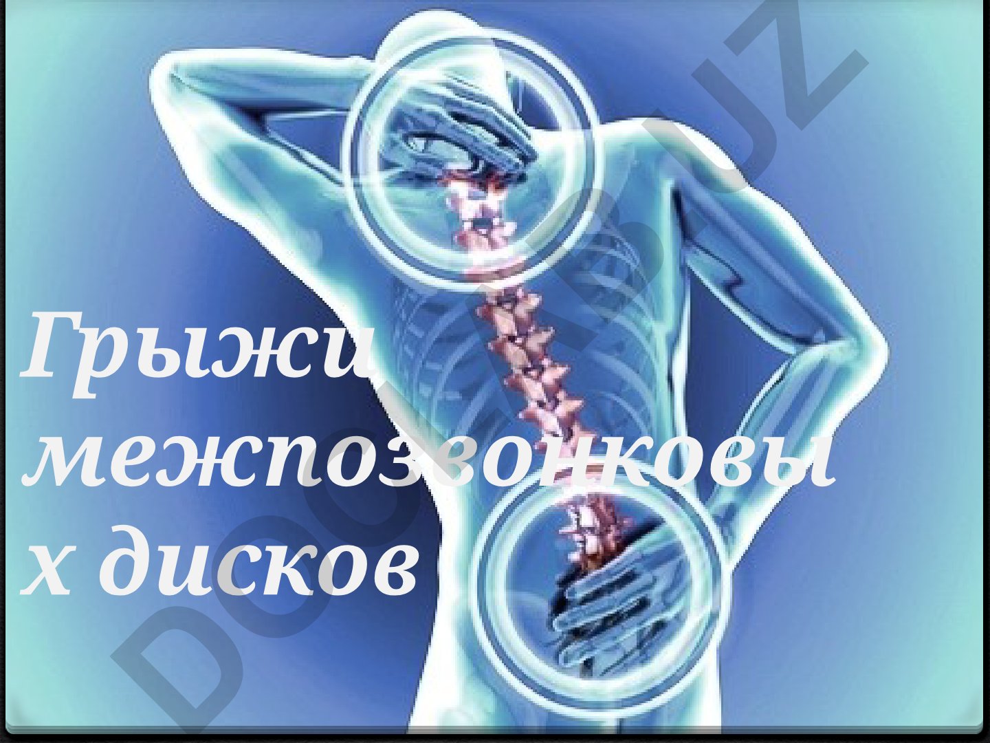 Грыжи межпозвонковых дисков и вертеброгенные боли