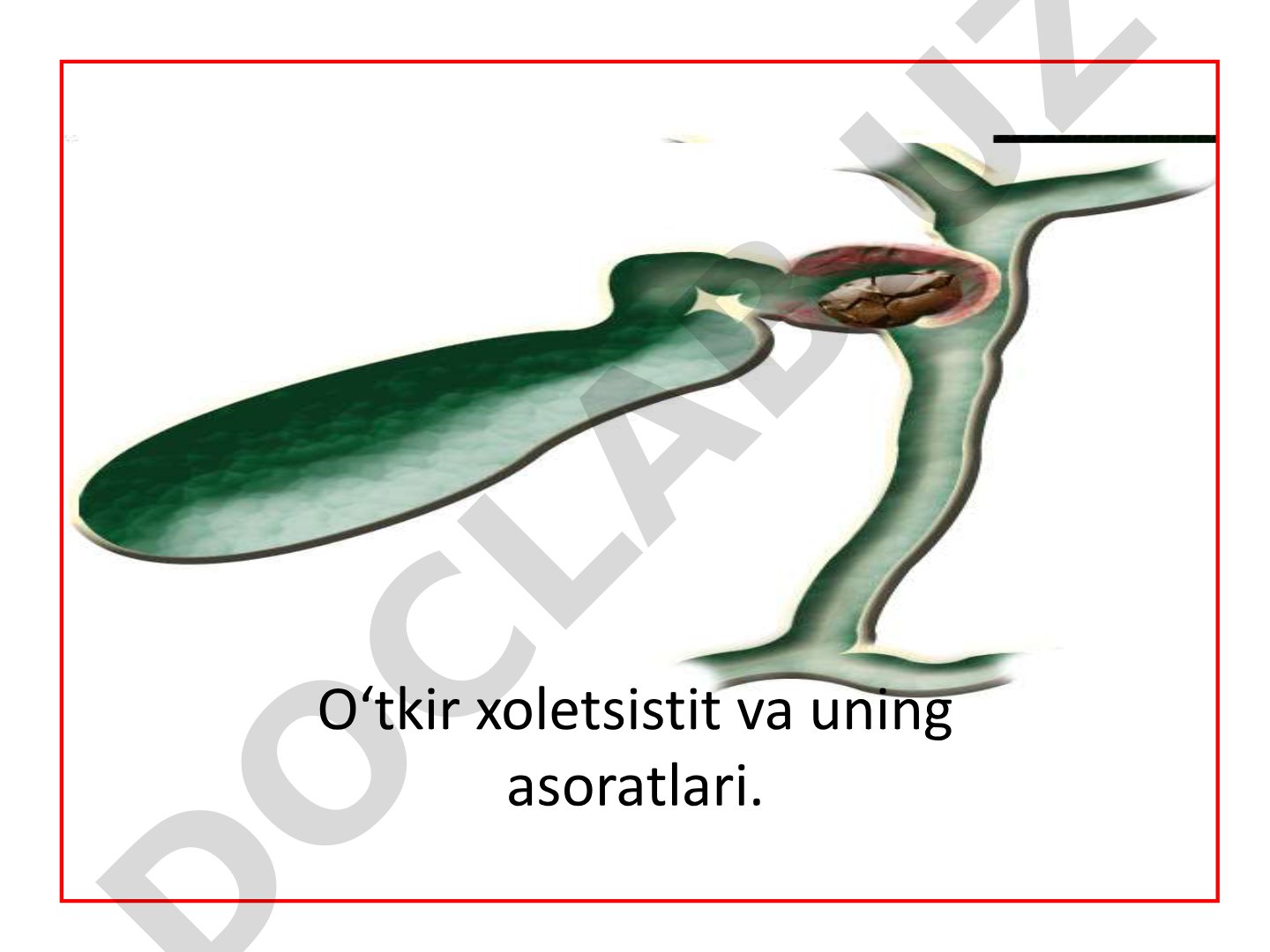 O‘tkir xoletsistit va uning asoratlari