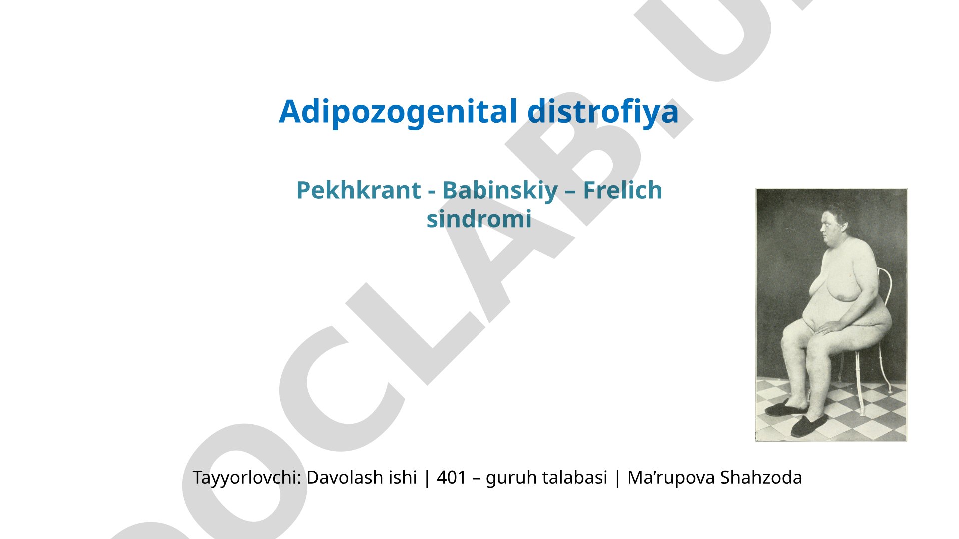 Adipozogenital distrofiya (Pekhkrant-Babinskiy-Frelich sindromi)