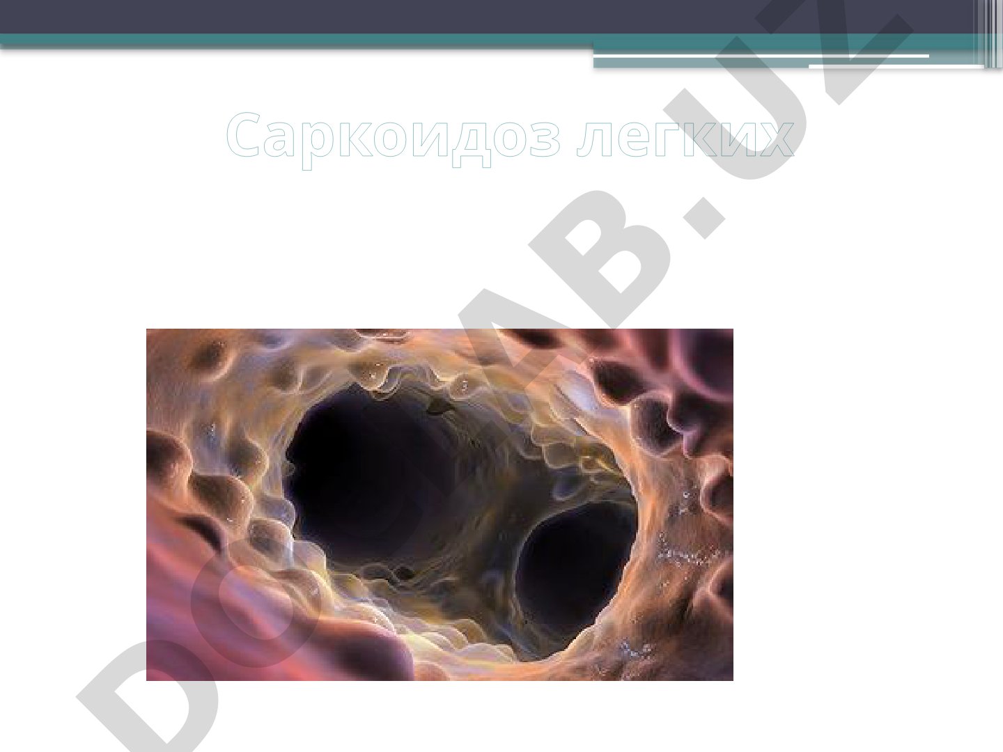 Саркоидоз легких