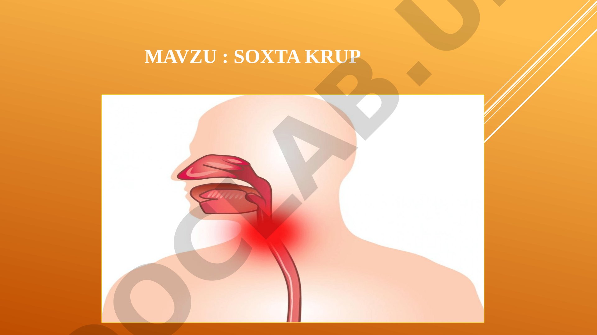 Soxta krup (halqumning o'tkir stenozi, laringotraxeit)