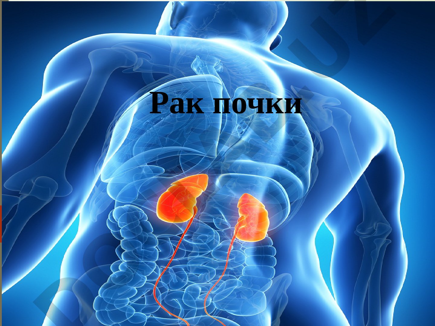 Рак почки: этиология, классификация, клиническая картина, диагностика