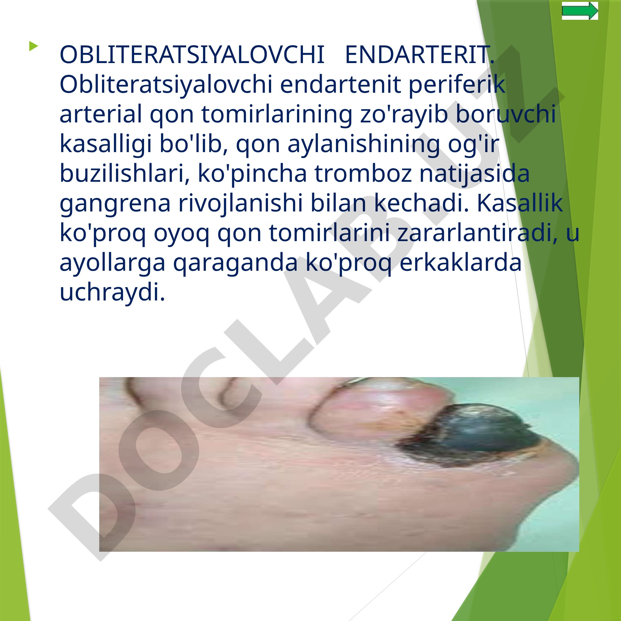 Obliteratsiyalovchi endarterit