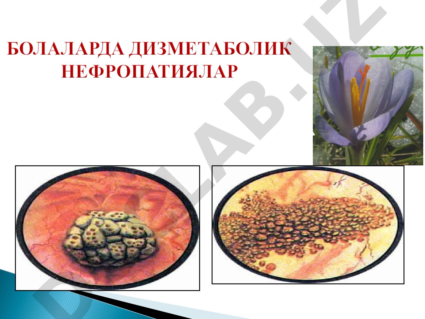Dismetabolik nefropatiyalar