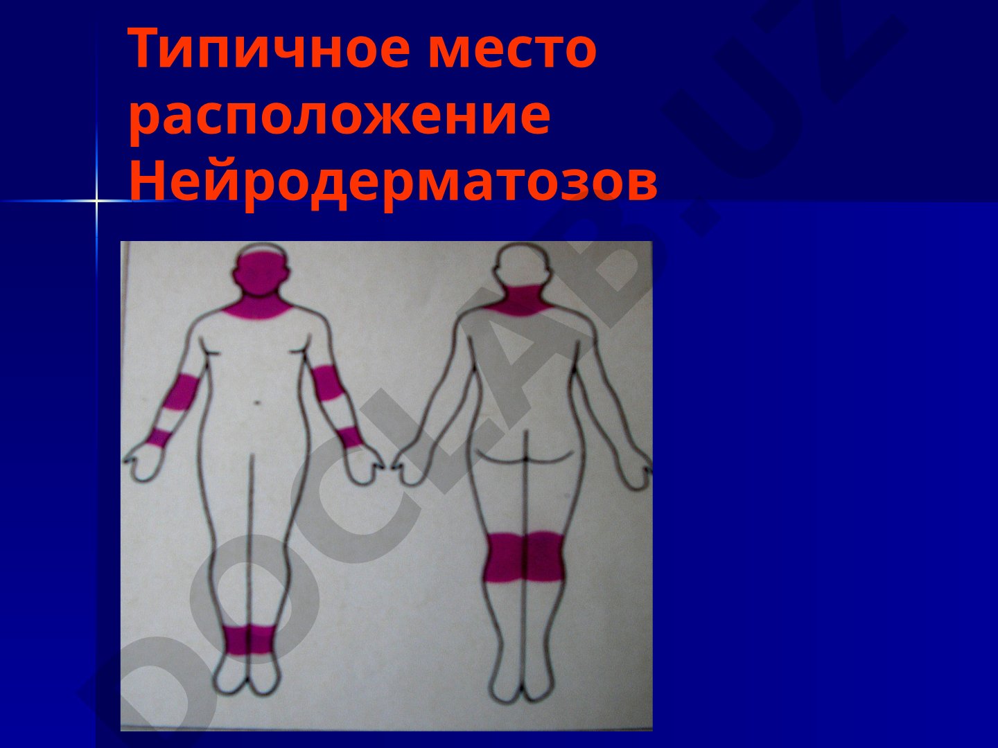 Нейродерматозы: классификация, локализация и лечение
