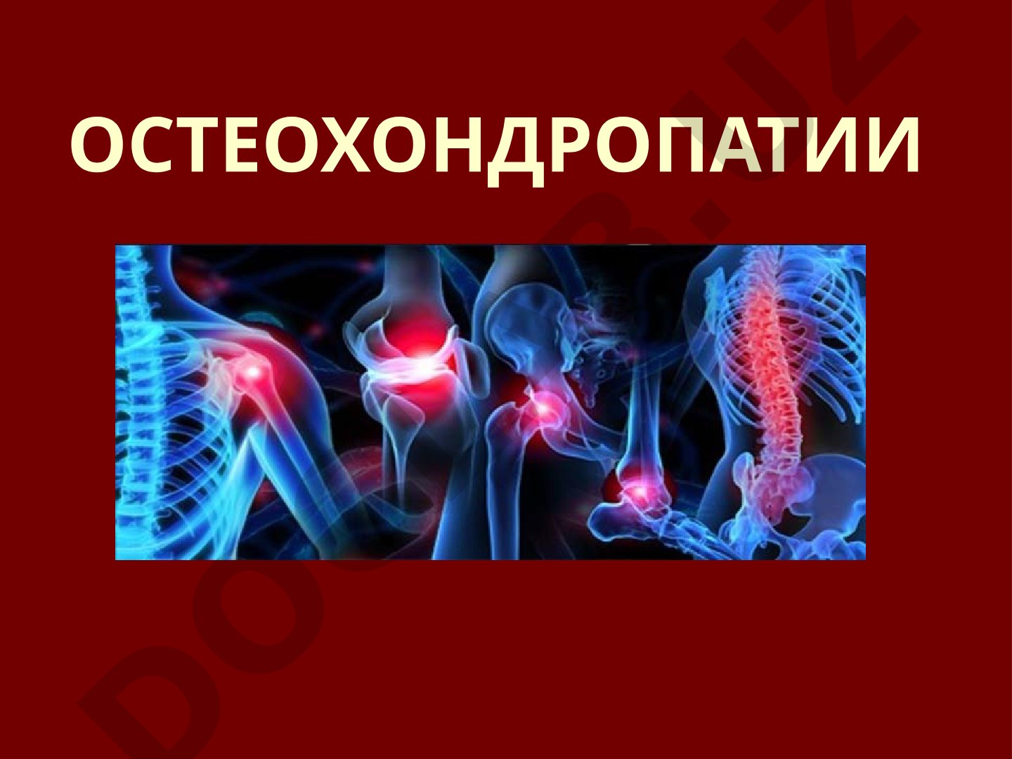 Остеохондропатии: определение и классификация
