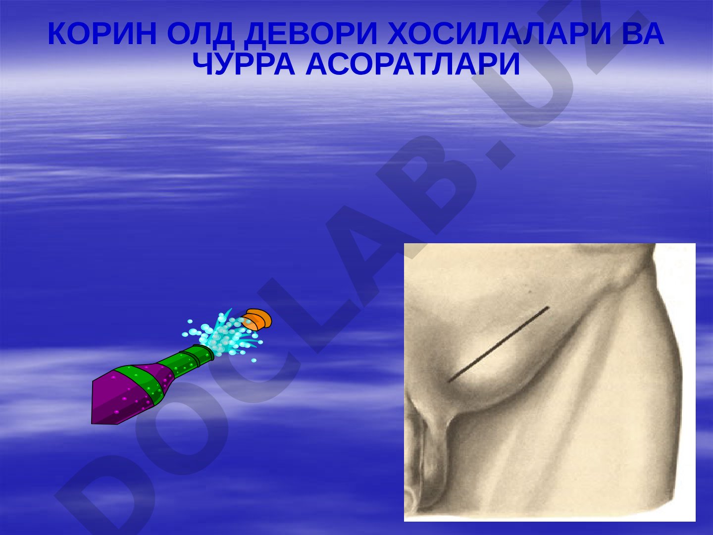 Корин олд девори хосилалари ва чурра асоратлари сабаблари