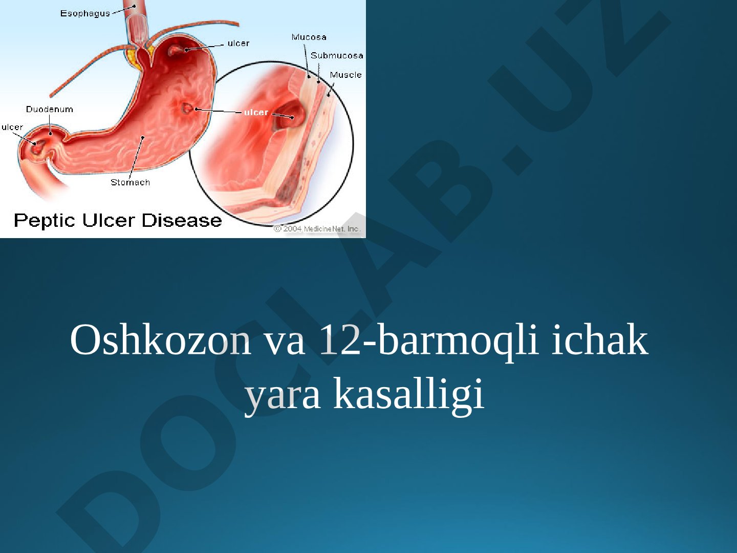 Oshkozon va 12-barmoqli ichak yara kasalligi