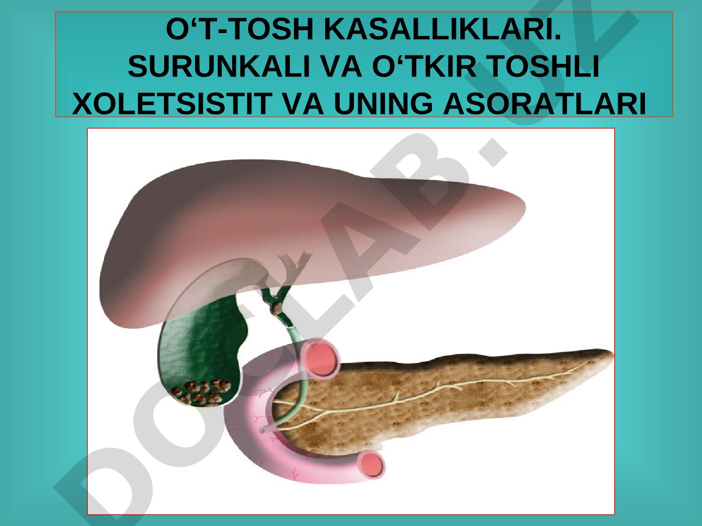 O't-tosh kasalliklari. Surunkali va o'tkir toshli xoletsistit va uning asoratlari