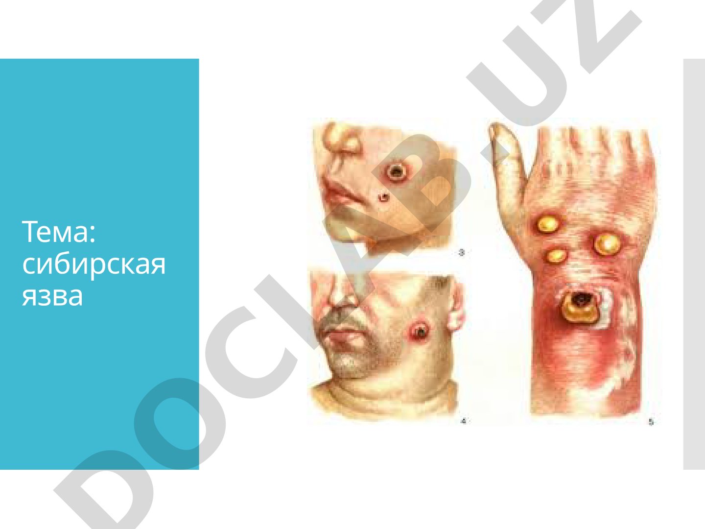 сибирская язва