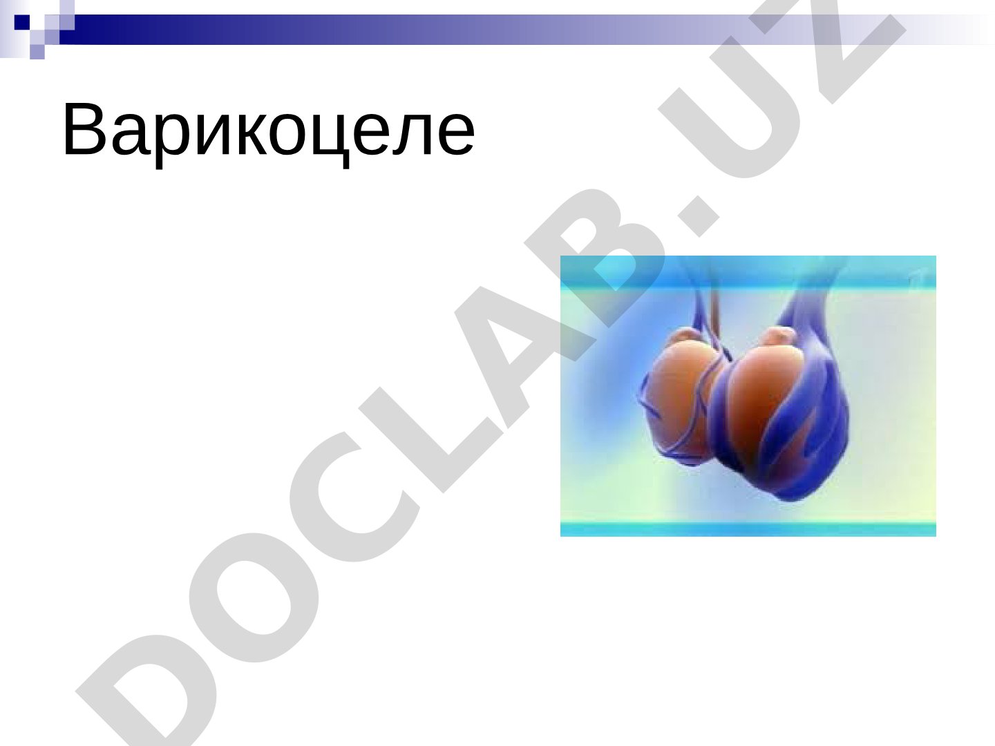 Варикоцеле