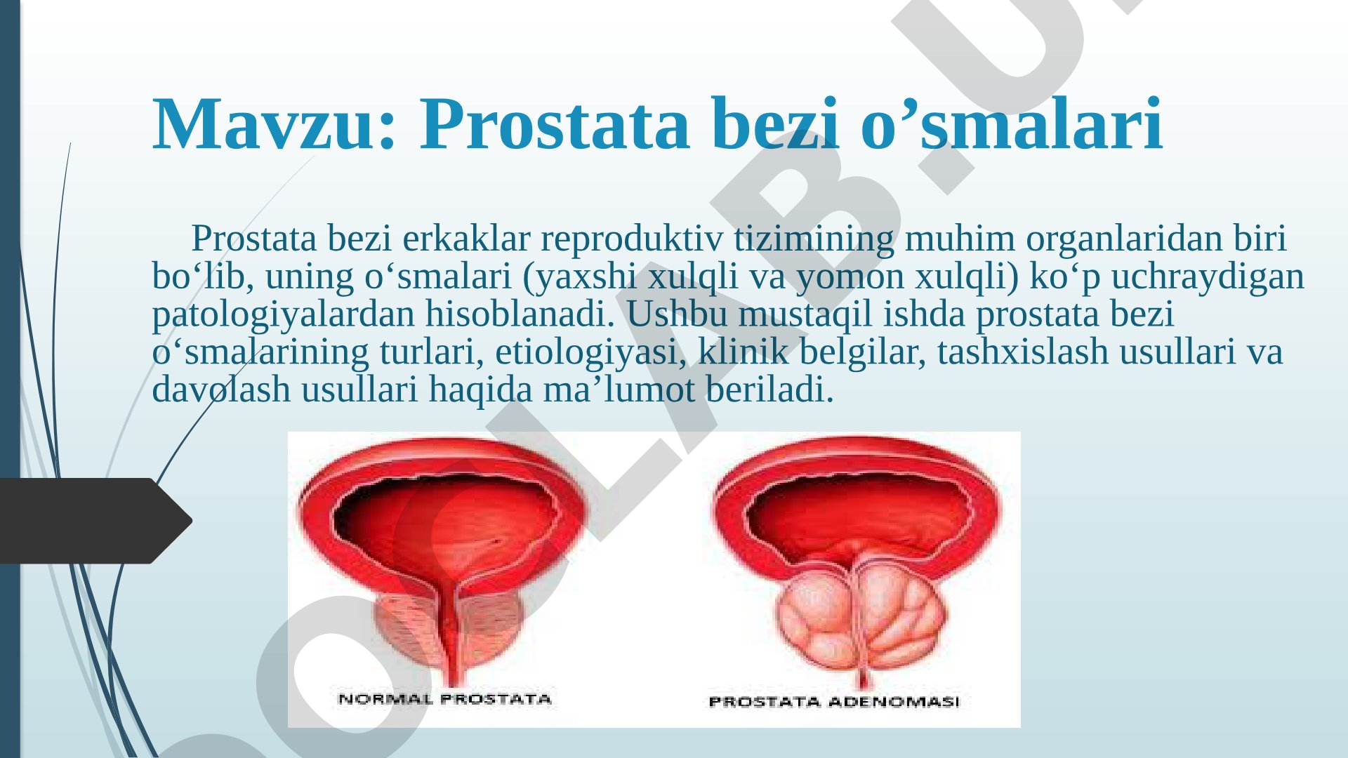 Prostata bezi o’smalari