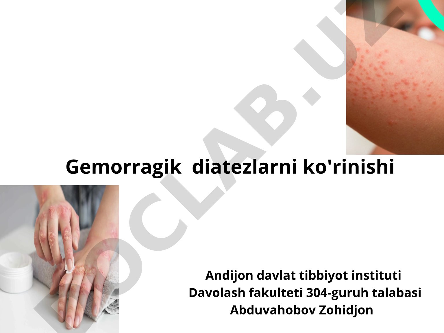 Gemorragik diatezlarning ko'rinishlari