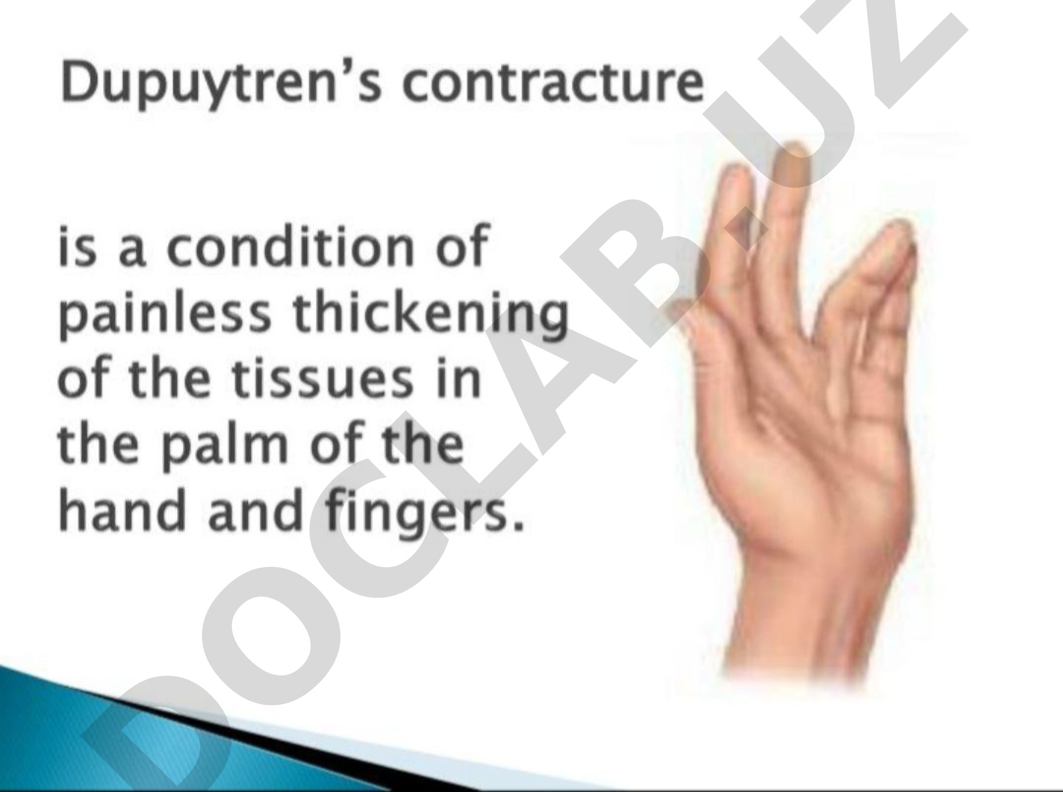 Dupuytren's contracture: painless thickening of hand and finger tissues